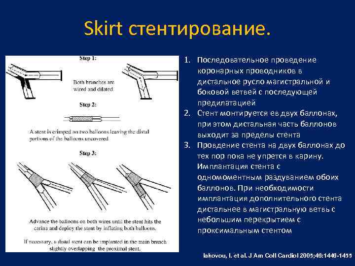 Skirt стентирование. 1. Последовательное проведение коронарных проводников в дистальное русло магистральной и боковой ветвей