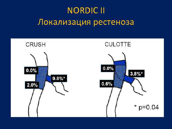 NORDIC II Локализация рестеноза 