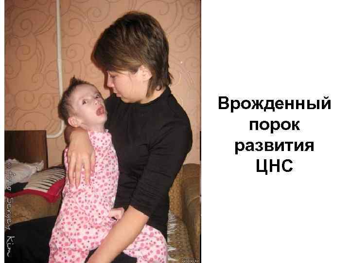 Врожденный порок развития ЦНС 