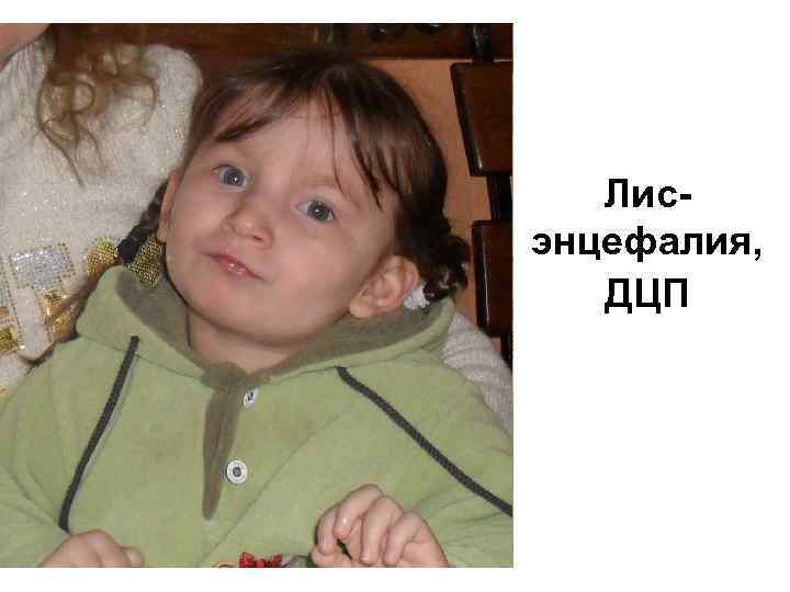 Лисэнцефалия, ДЦП 