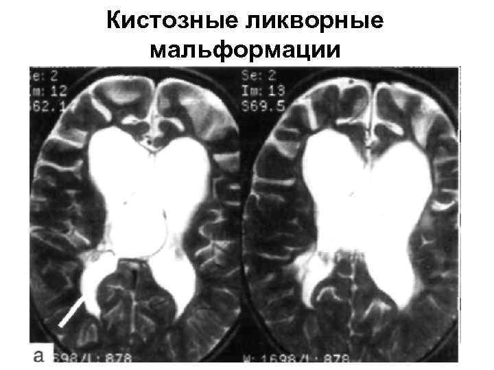 Кистозные ликворные мальформации 