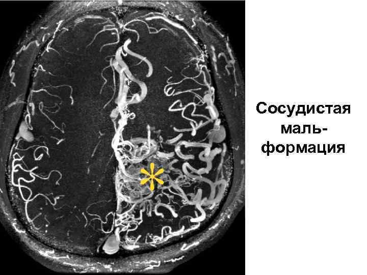 Сосудистая мальформация 