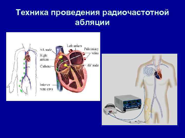 Радиочастотная термоабляция. Радиочастотная катетерная абляция. Катетерная абляция сердца что это такое. Операция на сердце абляция.