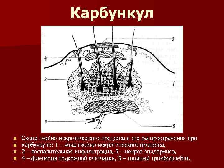 Корнилова схема бородавки