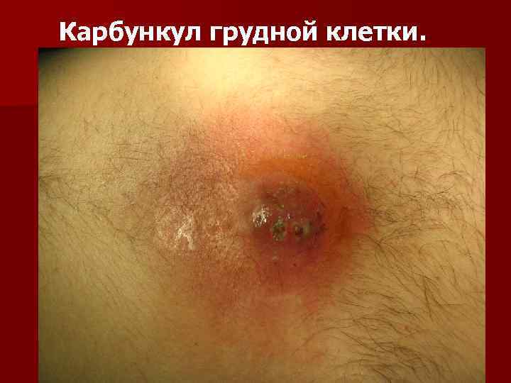 Карбункул грудной клетки. 