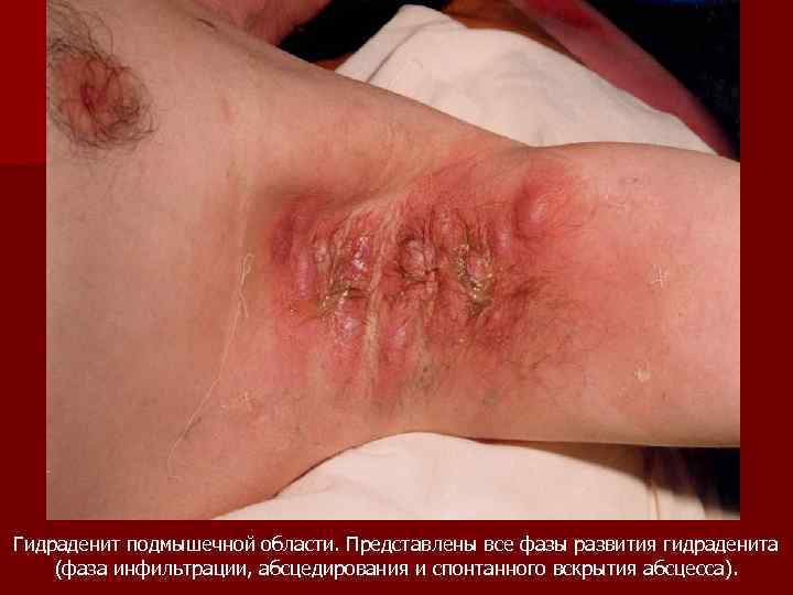 Гидраденит подмышечной области. Представлены все фазы развития гидраденита (фаза инфильтрации, абсцедирования и спонтанного вскрытия