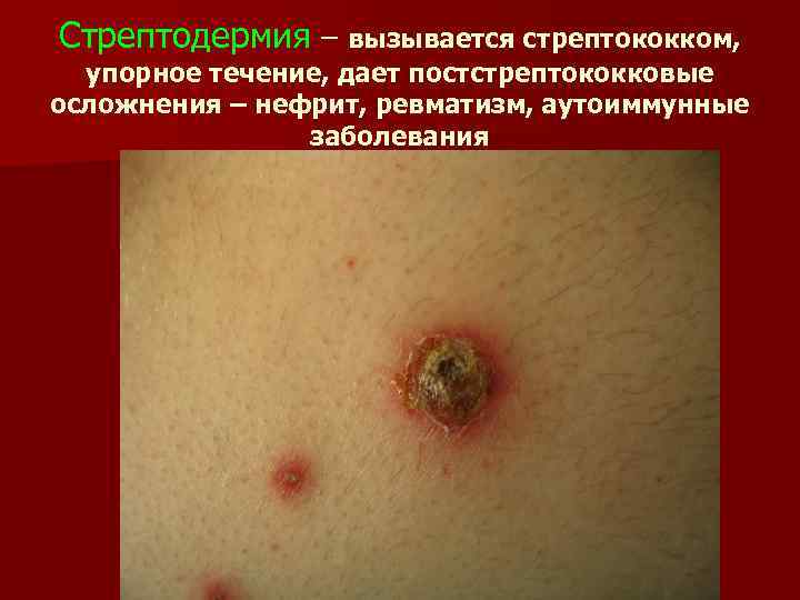Стрептодермия – вызывается стрептококком, упорное течение, дает постстрептококковые осложнения – нефрит, ревматизм, аутоиммунные заболевания