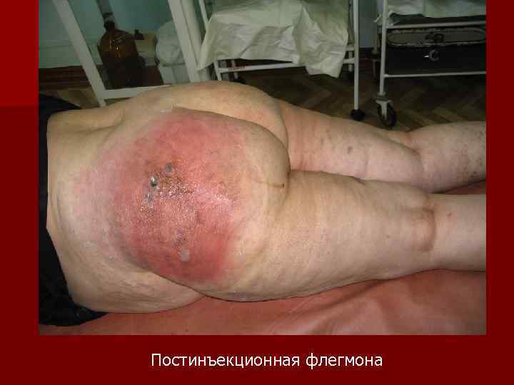 Постинъекционная флегмона 