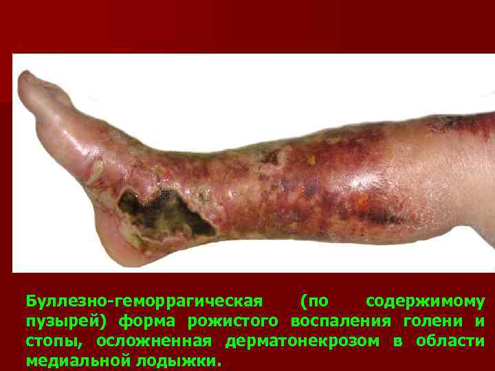 Буллезно-геморрагическая (по содержимому пузырей) форма рожистого воспаления голени и стопы, осложненная дерматонекрозом в области