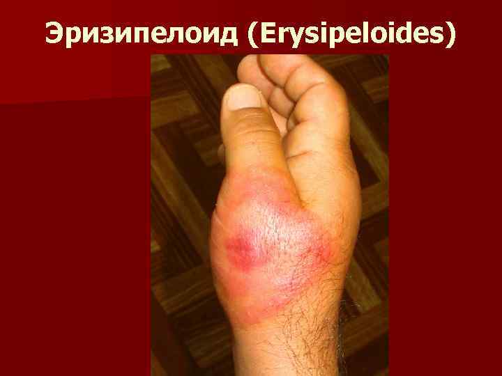 Эризипелоид (Erysipeloides) 