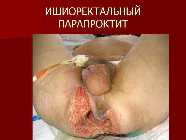 ИШИОРЕКТАЛЬНЫЙ ПАРАПРОКТИТ 