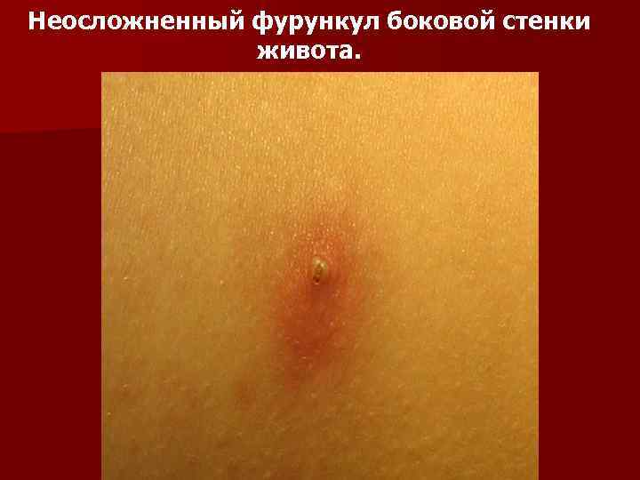 Неосложненный фурункул боковой стенки живота. 