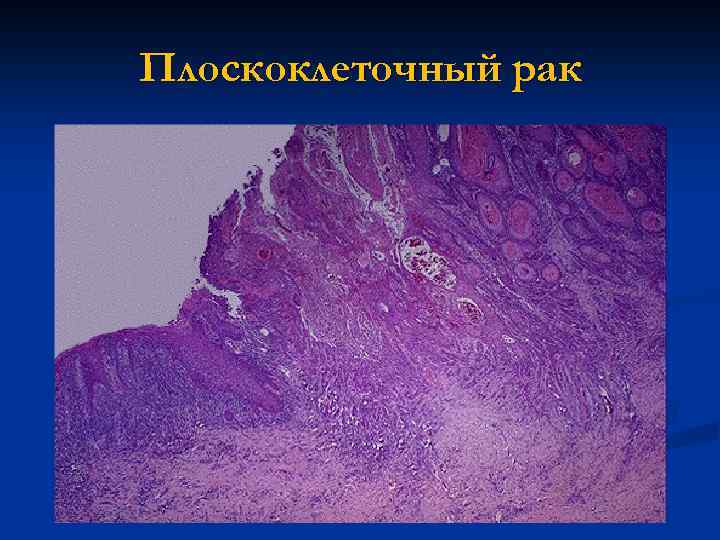 Низкодифференцированный плоскоклеточный рак