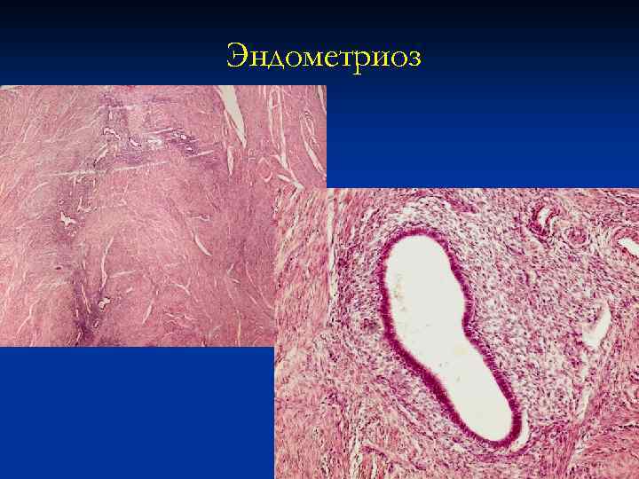 Эндометриоз 