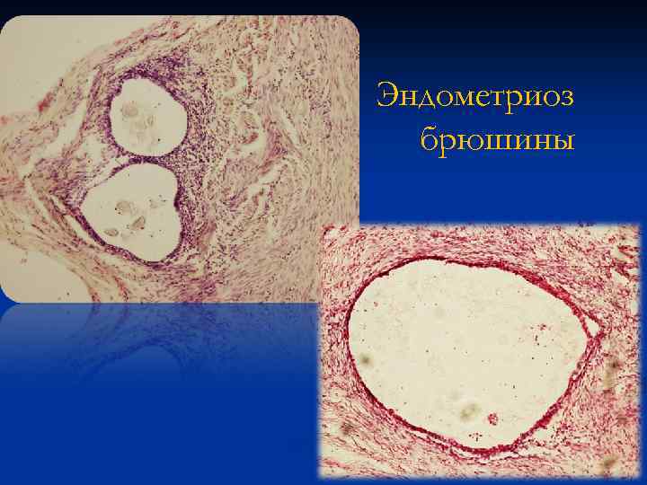 Эндометриоз брюшины 