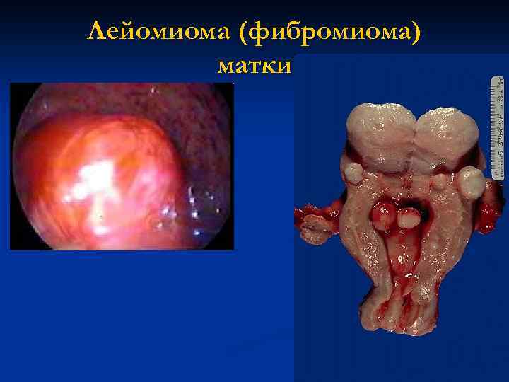Лейомиома (фибромиома) матки 