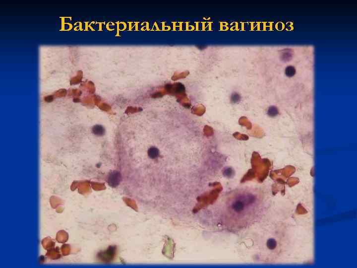 Бактериальный вагиноз 