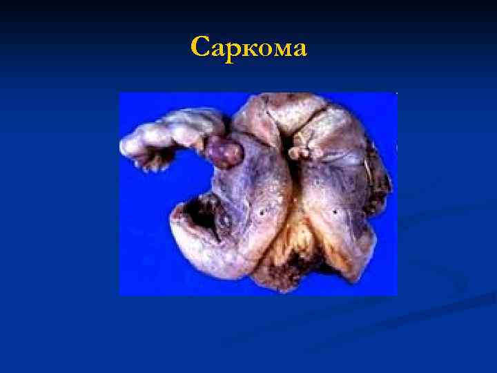 Саркома 