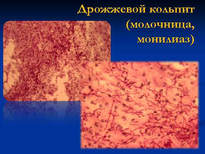 Дрожжевой кольпит (молочница, монилиаз) 