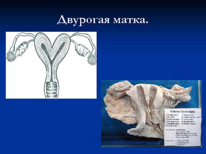 Двурогая матка. 