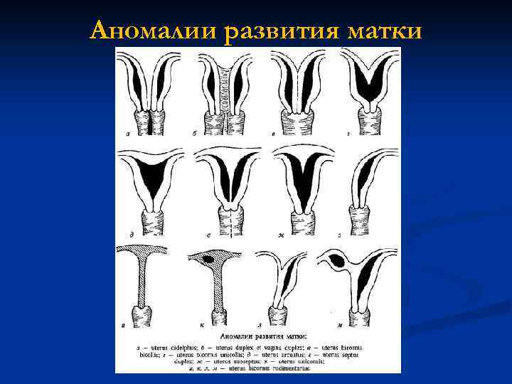 Аномалии развития матки 