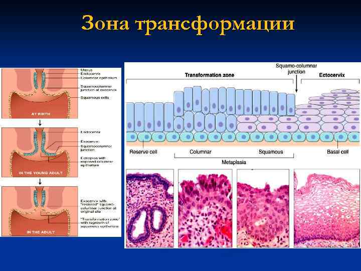 Эндоцервикс плоский и цилиндрический эпителий