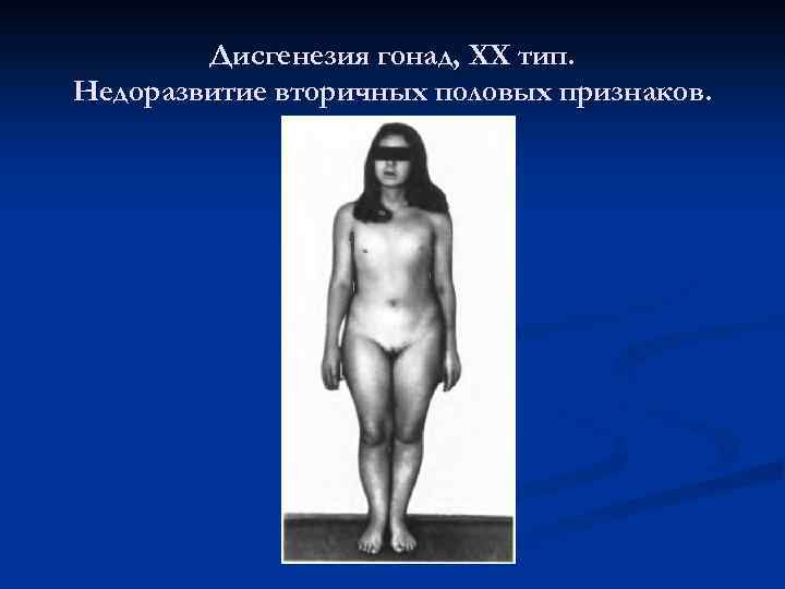 Дисгенезия гонад, ХХ тип. Недоразвитие вторичных половых признаков. 