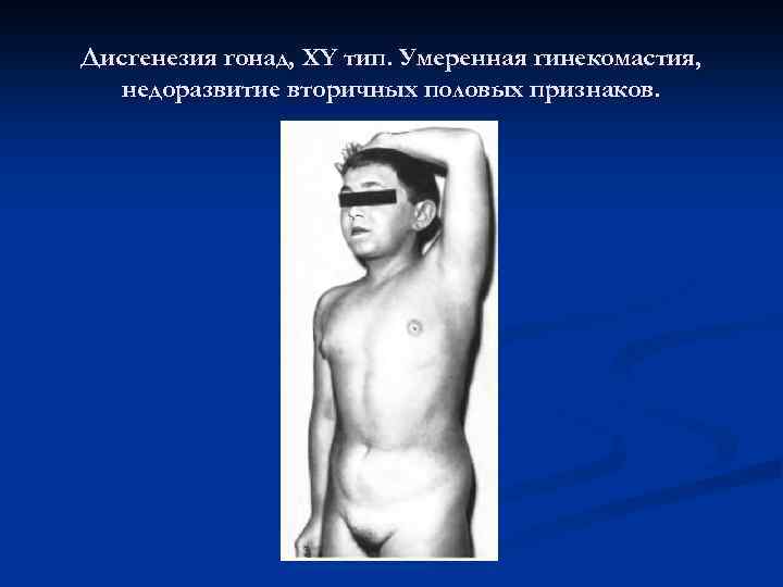 Дисгенезия гонад, ХY тип. Умеренная гинекомастия, недоразвитие вторичных половых признаков. 