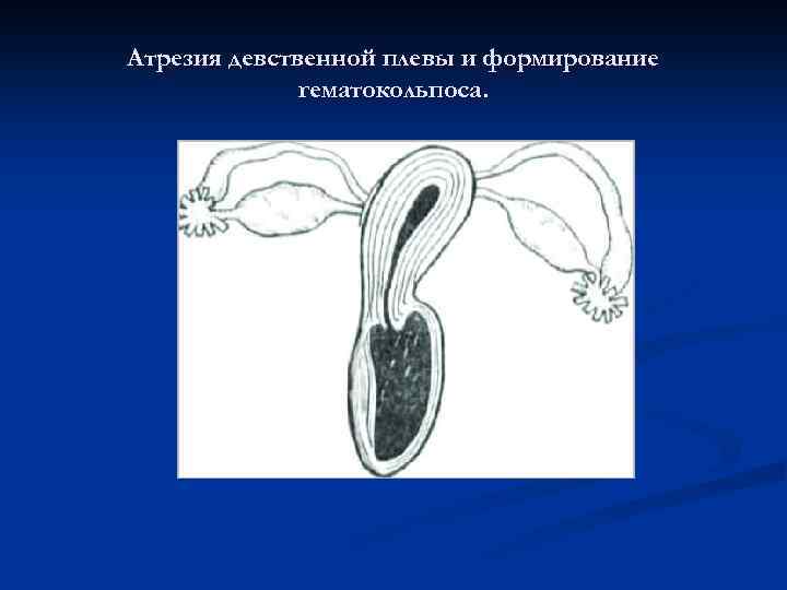 Атрезия девственной плевы и формирование гематокольпоса. 