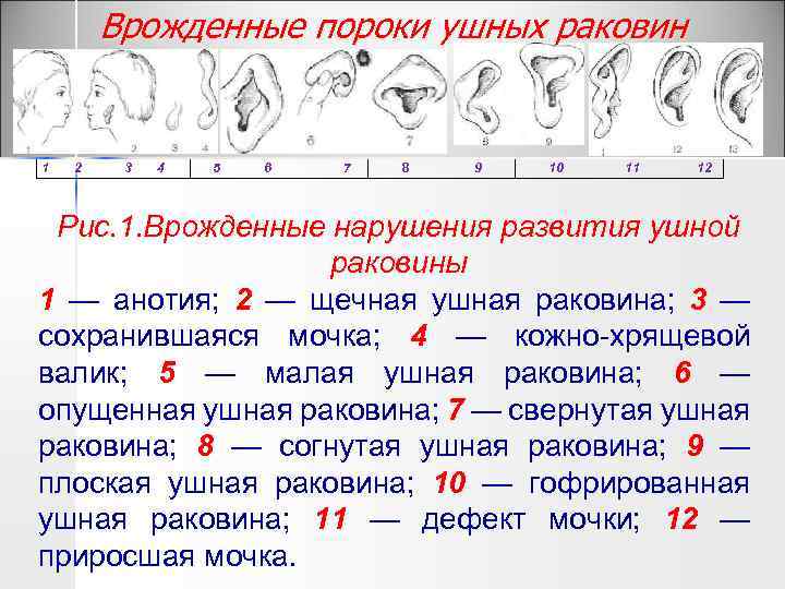 Врожденные пороки ушных раковин 1 2 3 4 5 6 7 8 9 10