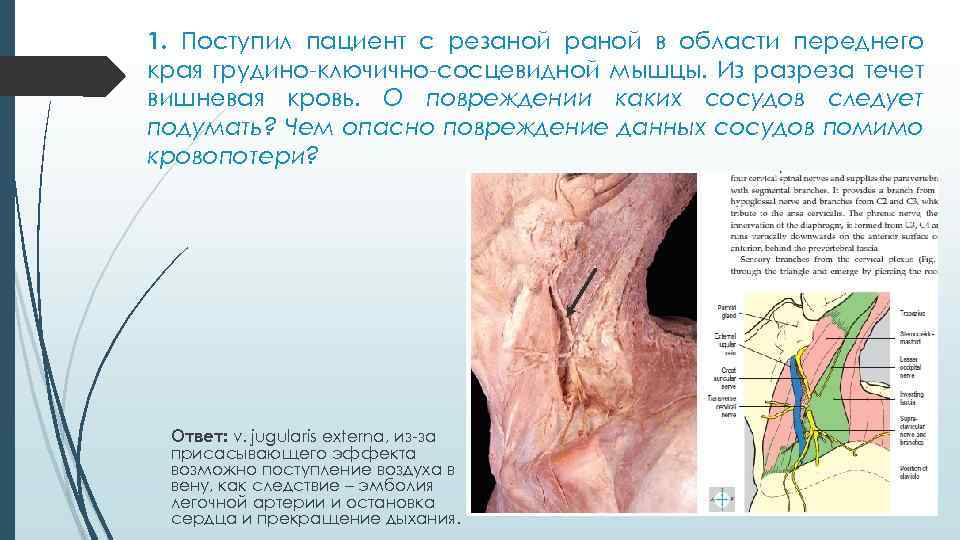 1. Поступил пациент с резаной раной в области переднего края грудино ключично сосцевидной мышцы.