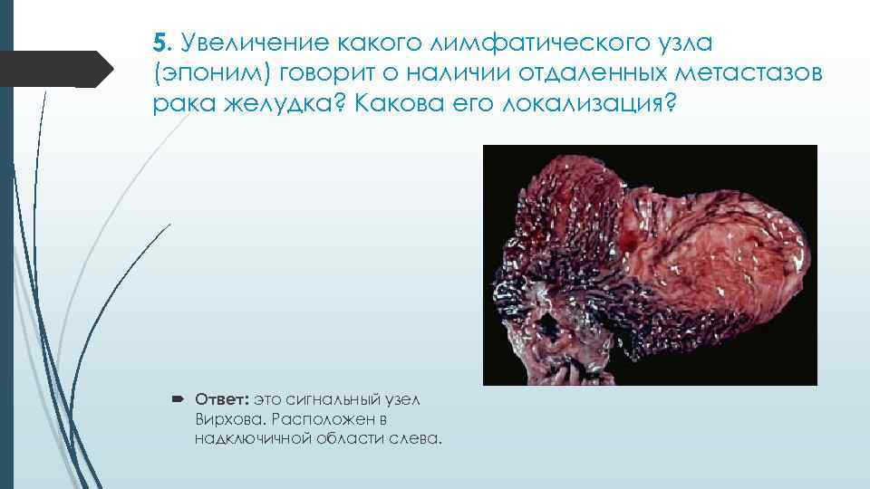 5. Увеличение какого лимфатического узла (эпоним) говорит о наличии отдаленных метастазов рака желудка? Какова