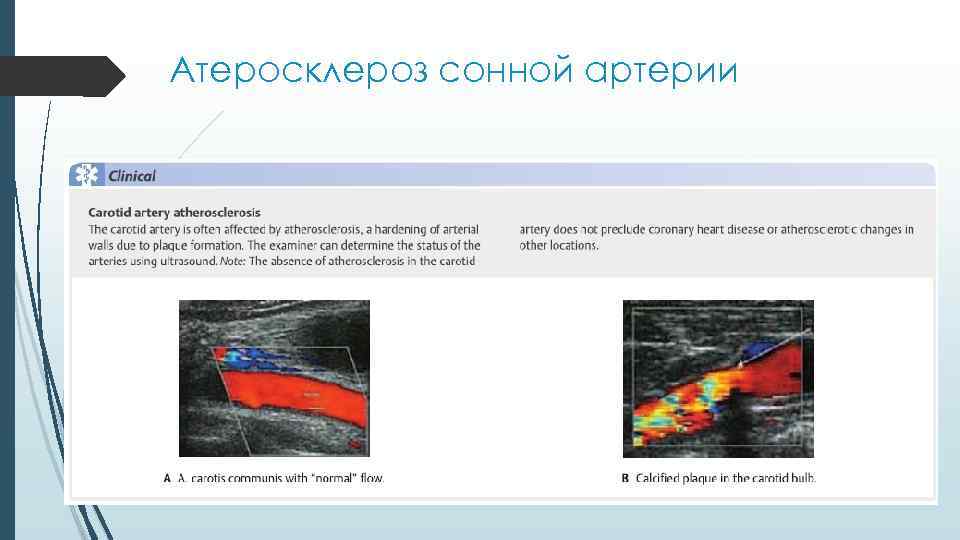 Атеросклероз сонной артерии 