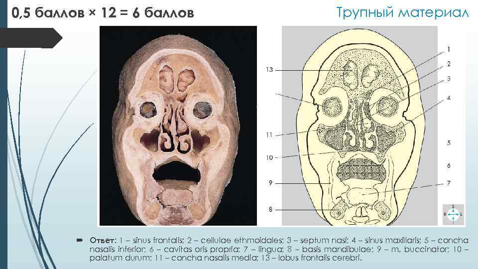 0, 5 баллов × 12 = 6 баллов Трупный материал Ответ: 1 – sinus