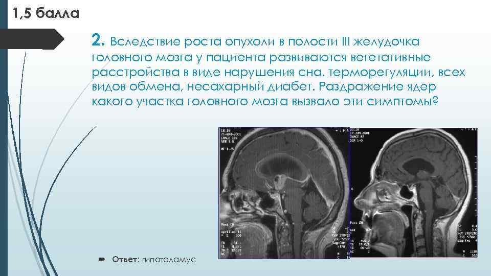 1, 5 балла 2. Вследствие роста опухоли в полости III желудочка головного мозга у