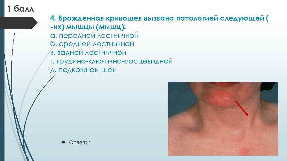 1 балл 4. Врожденная кривошея вызвана патологией следующей ( -их) мышцы (мышц): а. передней