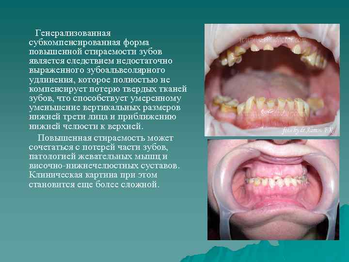 Генерализованная субкомпенсированная форма повышенной стираемости зубов является следствием недостаточно выраженного зубоальвеолярного удлинения, которое полностью