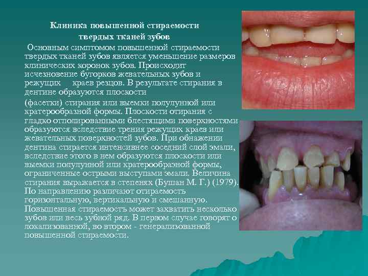 Клиника повышенной стираемости твердых тканей зубов Основным симптомом повышенной стираемости твердых тканей зубов является