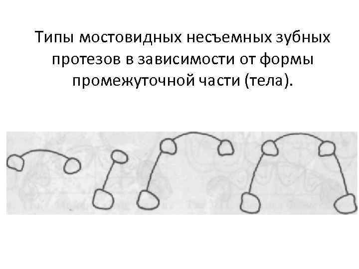 Части мостовидного протеза. Формы промежуточной части мостовидного протеза. Виды промежуточной части мостовидного протеза. Промывная часть мостовидного протеза. Седловидная форма мостовидного протеза.