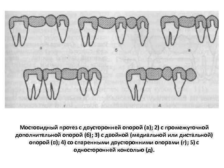 Мостовидный протез с двусторонней опорой (а); 2) с промежуточной дополнительной опорой (б); 3) с