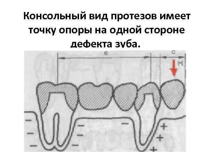 Консольный протез. Мостовидный протез с опорой на 2 зуба. Консольный мостовидный протез. Мостовидные протезы с односторонней опорой. Мостовидный протез с односторонней опорой.