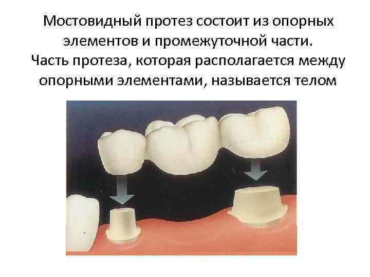 Виды мостовидных протезов. Конструктивные элементы мостовидного протеза. Опорные элементы мостовидного протеза. Составные элементы мостовидного протеза. Промежуточная часть (тело) мостовидного протеза.