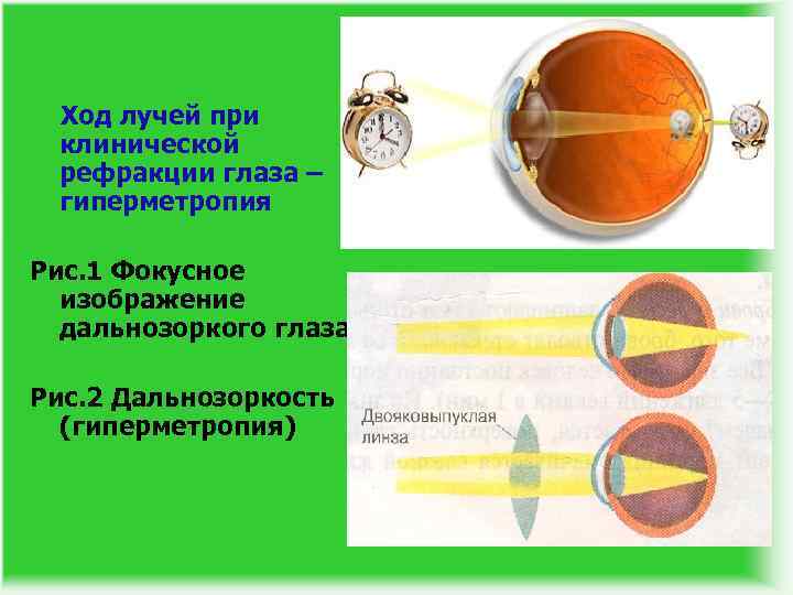 Гиперметропия 1 степени глаз