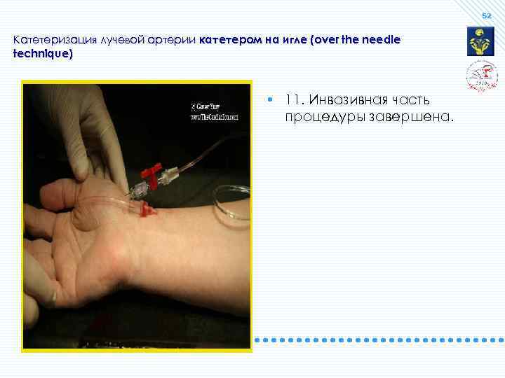 52 Катетеризация лучевой артерии катетером на игле (over the needle technique) • 11. Инвазивная