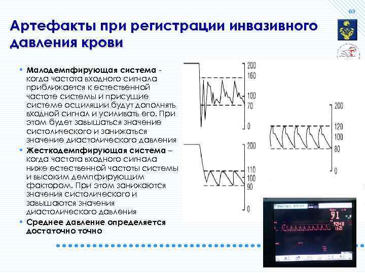 63 Артефакты при регистрации инвазивного давления крови • Малодемпфирующая система когда частота входного сигнала