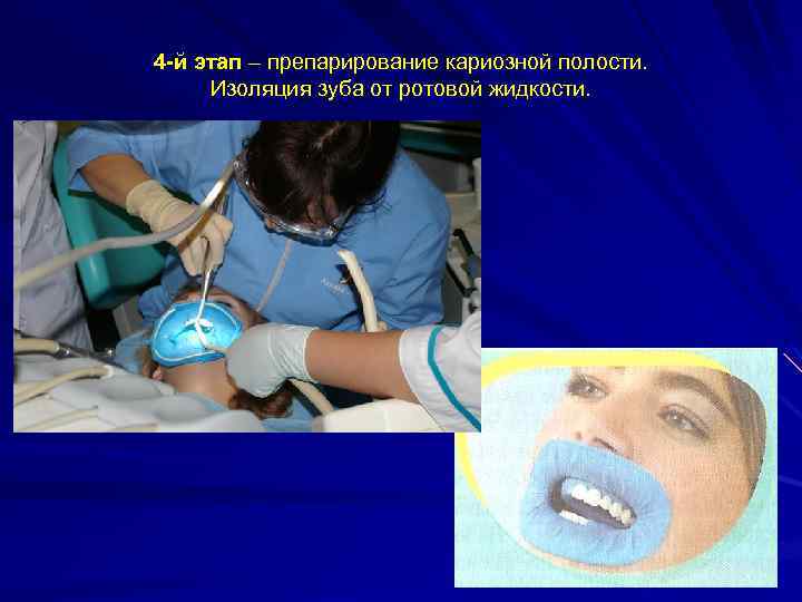 4 -й этап – препарирование кариозной полости. Изоляция зуба от ротовой жидкости. 