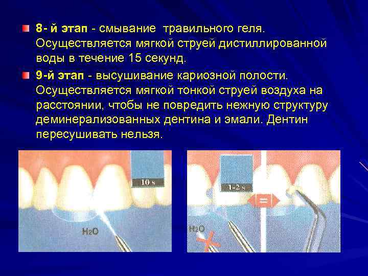 Протокол адгезивной фиксации керамических реставраций презентация