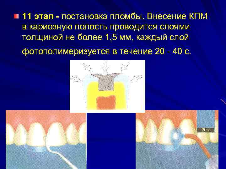 Пломбирование кариозных полостей временных. Этапы пломбирования кариозных полостей. Этапы постановки пломбы. Этапы пломбирования кариозных полостей композиционным материалом. Этапы пломбирования стеклоиономерным цементом зубов.