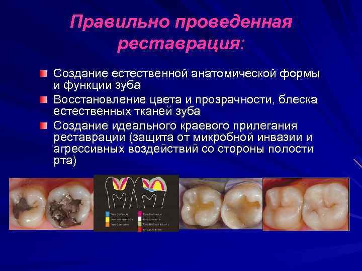 Правильно проведенная реставрация: Создание естественной анатомической формы и функции зуба Восстановление цвета и прозрачности,