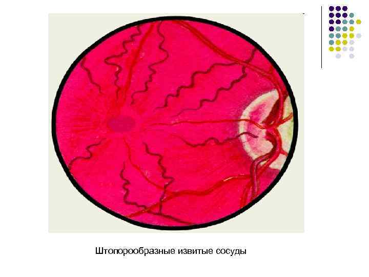 Штопорообразные извитые сосуды 